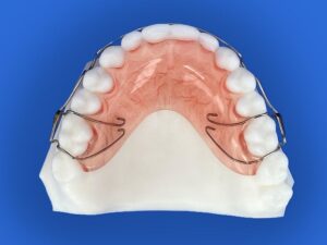 Retention-Hawley-Retainer-1