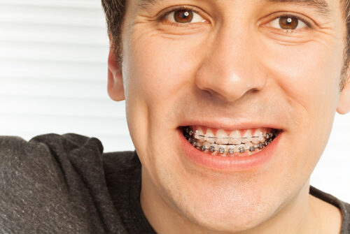 clear-braces-difference clear-braces-difference
